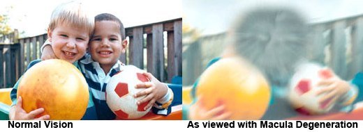 Comparison of a scene seen with normal vision and with macular degeneration